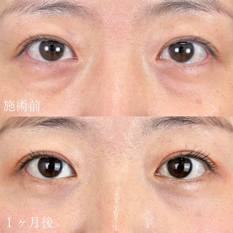 TCBのクマ取りの症例