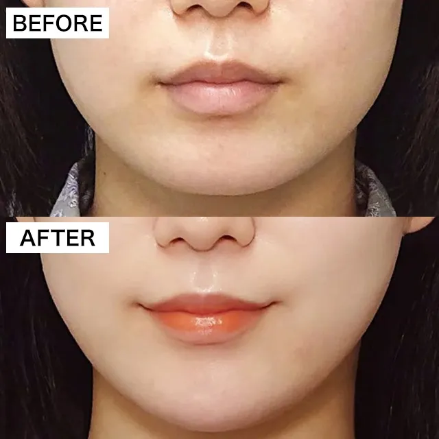 TCBのボトックスの症例