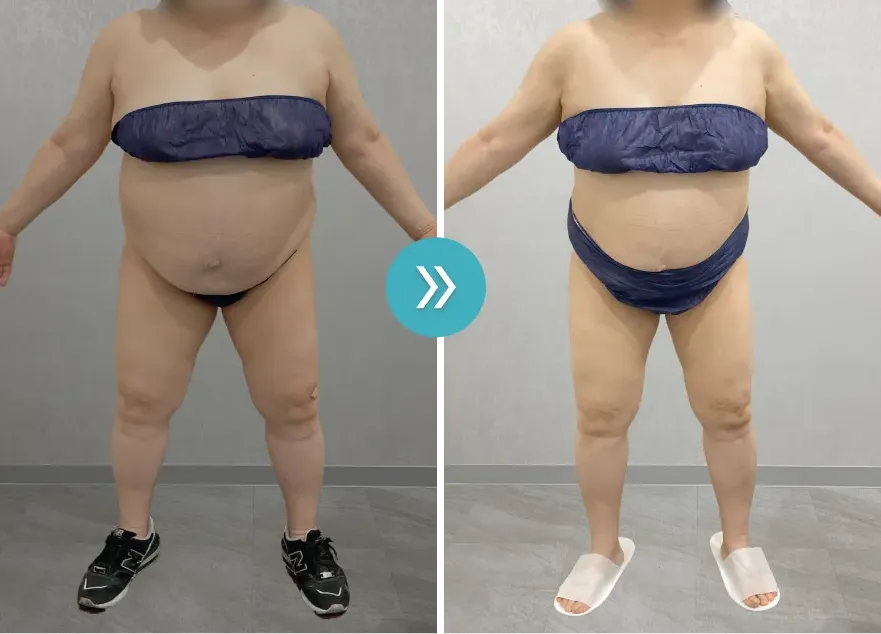 URARAクリニック医療ダイエットモニターの症例