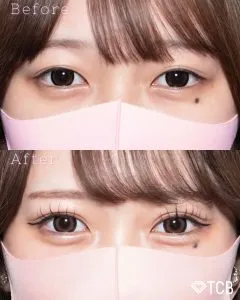 TCBの二重埋没法の症例