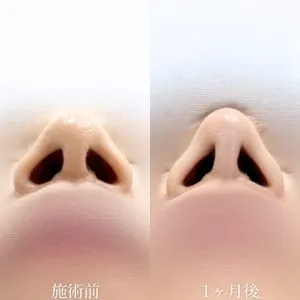 TCBメッシュの症例