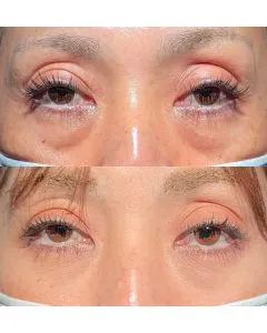 TCBのクマ取りの症例