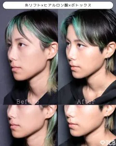 TCBのリフトアップの症例