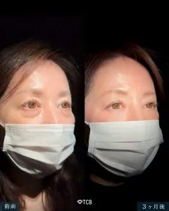 TCBのたるみ取りの症例