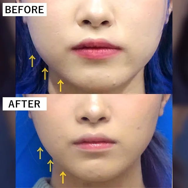 TCBのボトックスの症例