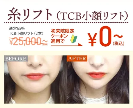 糸リフト症例