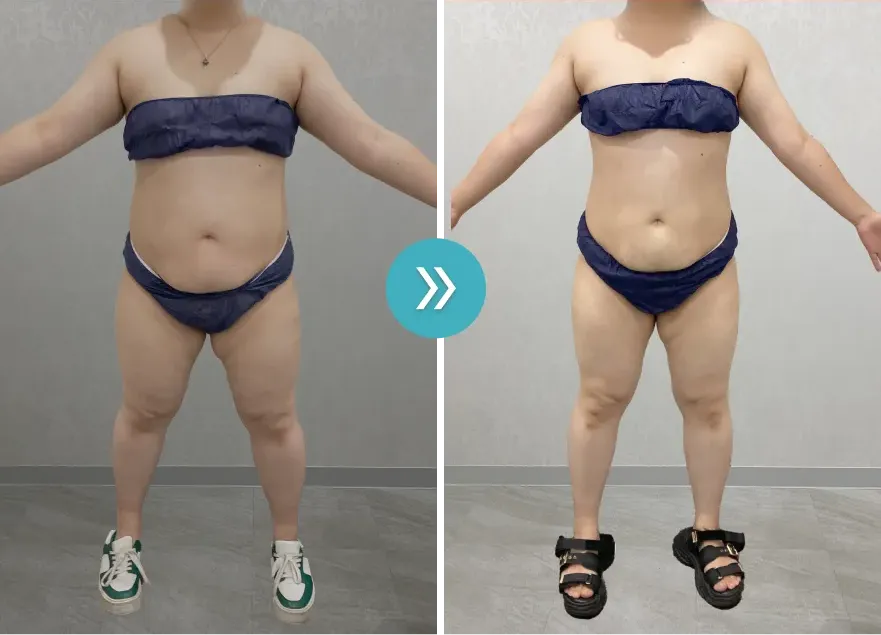 URARAクリニック医療ダイエットモニターの症例