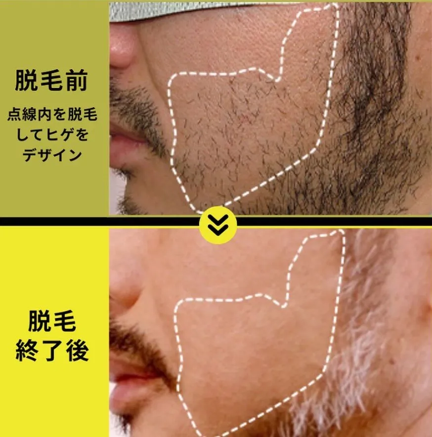 TBCヒゲ脱毛の症例①