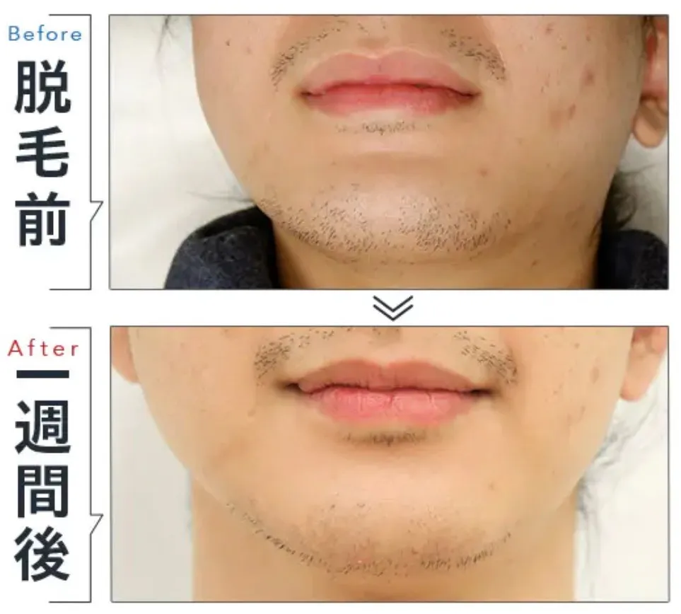 TBCヒゲ脱毛の症例②