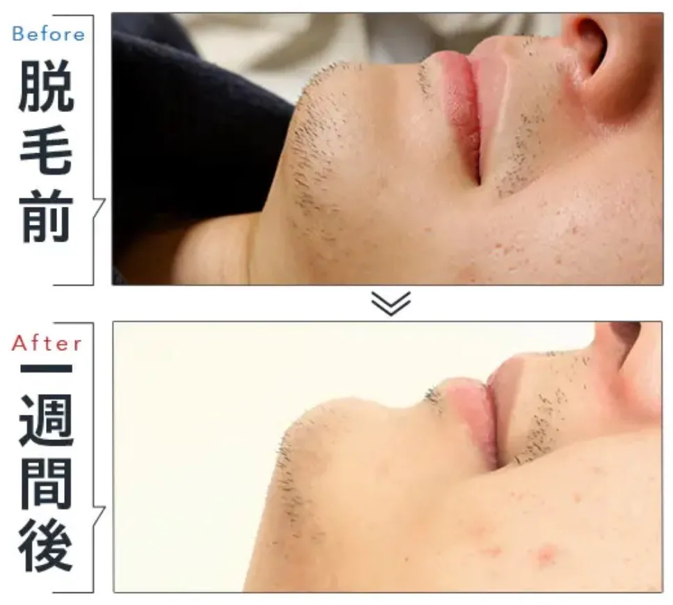 TBCヒゲ脱毛の症例③