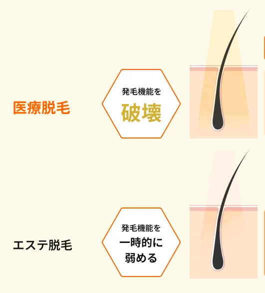 中野区付近にあるレジーナクリニックの医療脱毛とエステ脱毛の違い