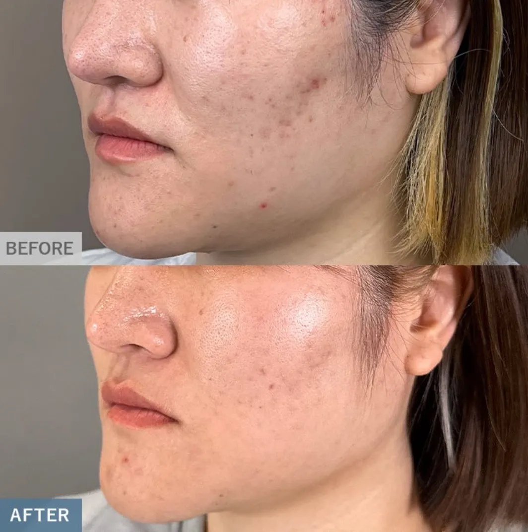 TCBダーマペンの症例①