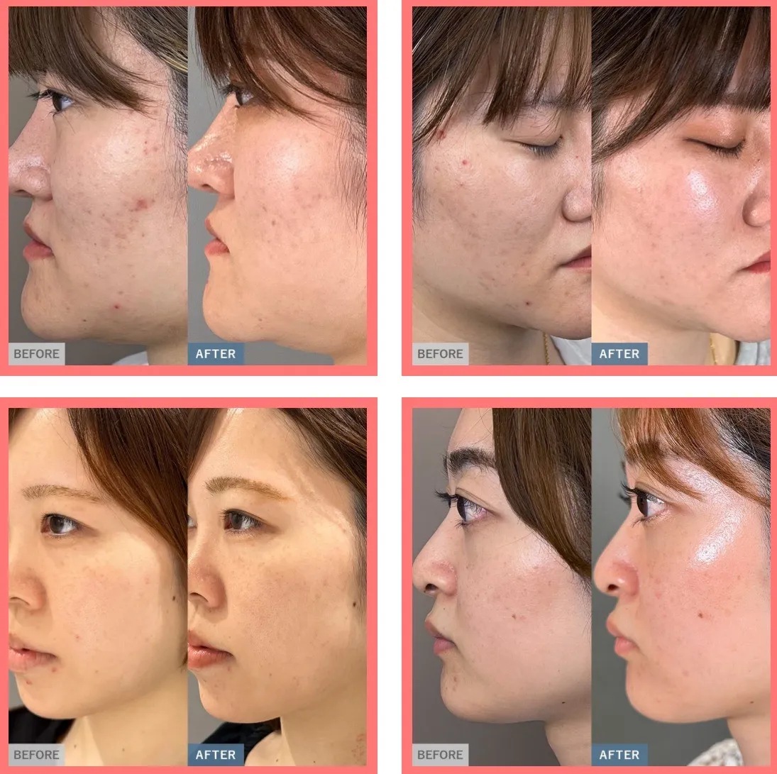 TCBダーマペンの症例②