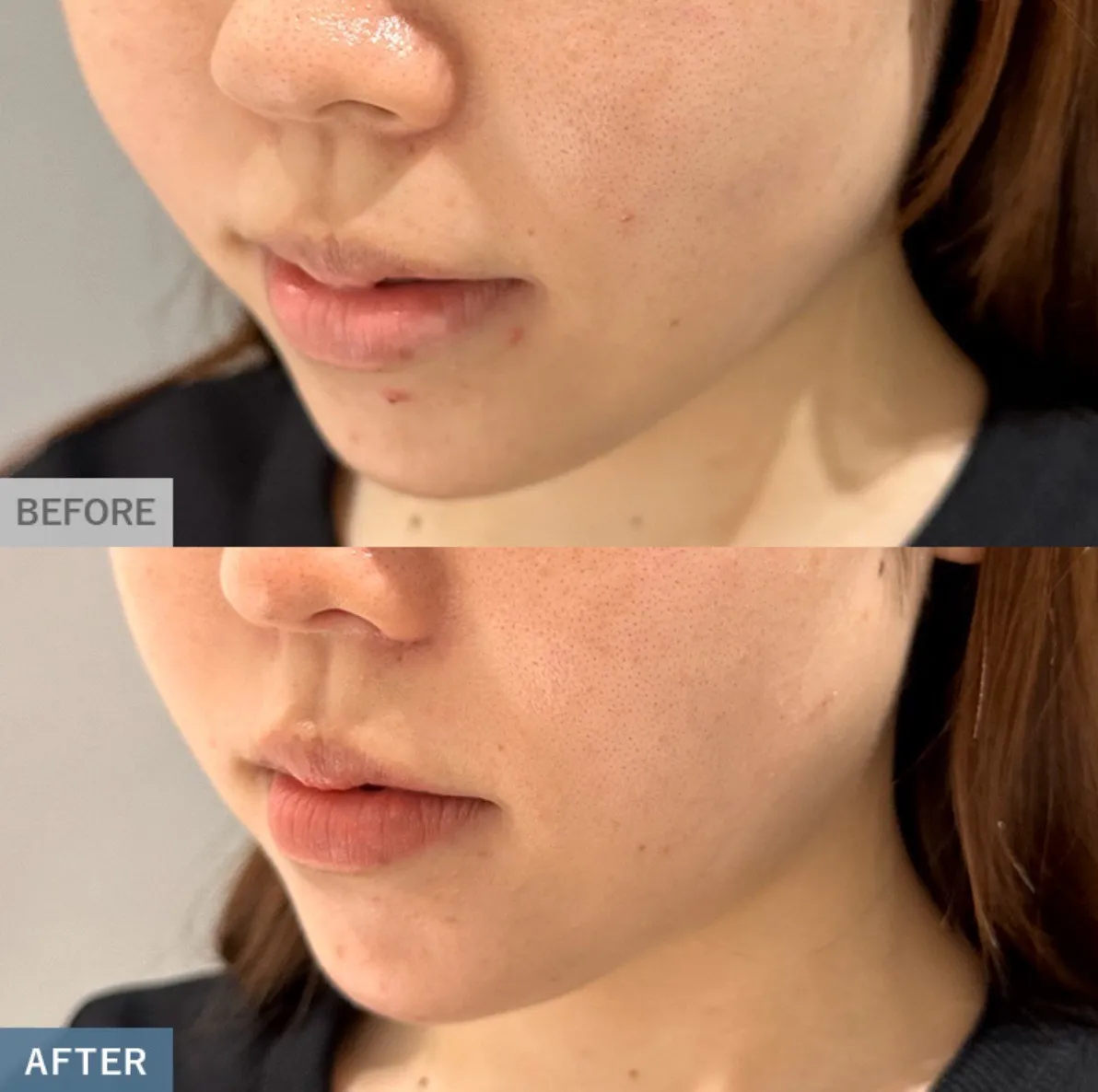 TCBダーマペンの症例③