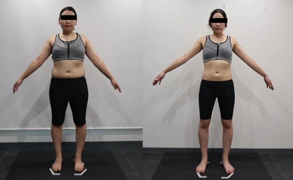 ディオクリニックの医療ダイエットの症例