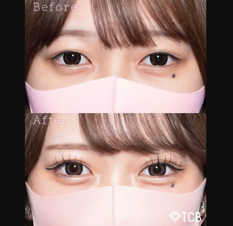 TCBの二重整形の症例