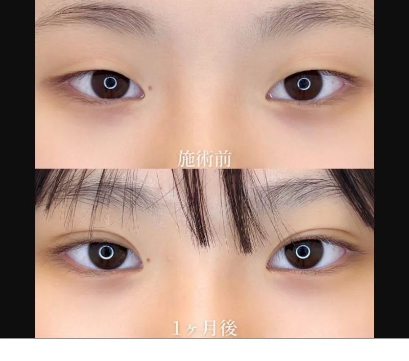 TCBの二重整形の症例