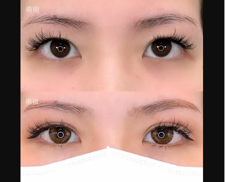 TCBの二重整形の症例