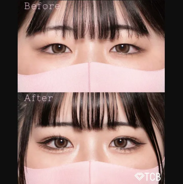 TCBの二重整形の症例