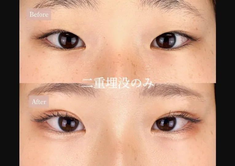 TCBの二重整形の症例