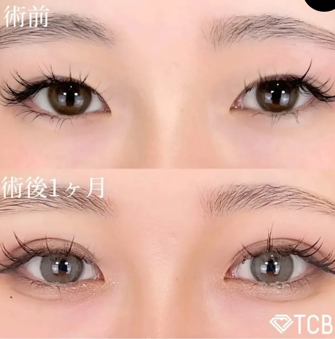TCB二重埋没法の症例①