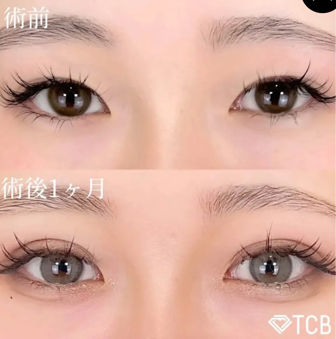 TCB二重の症例①