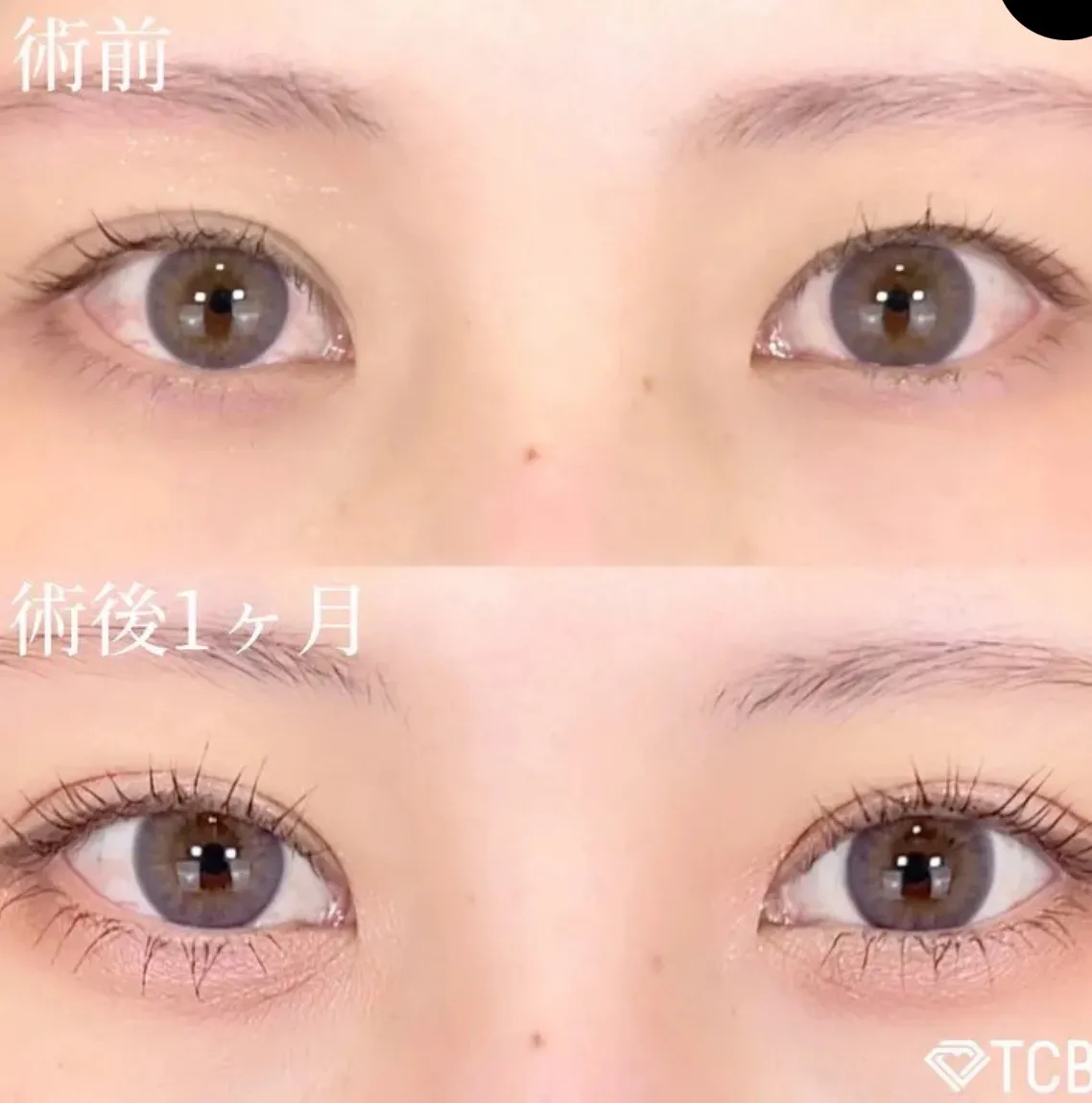 TCB二重埋没法の症例②