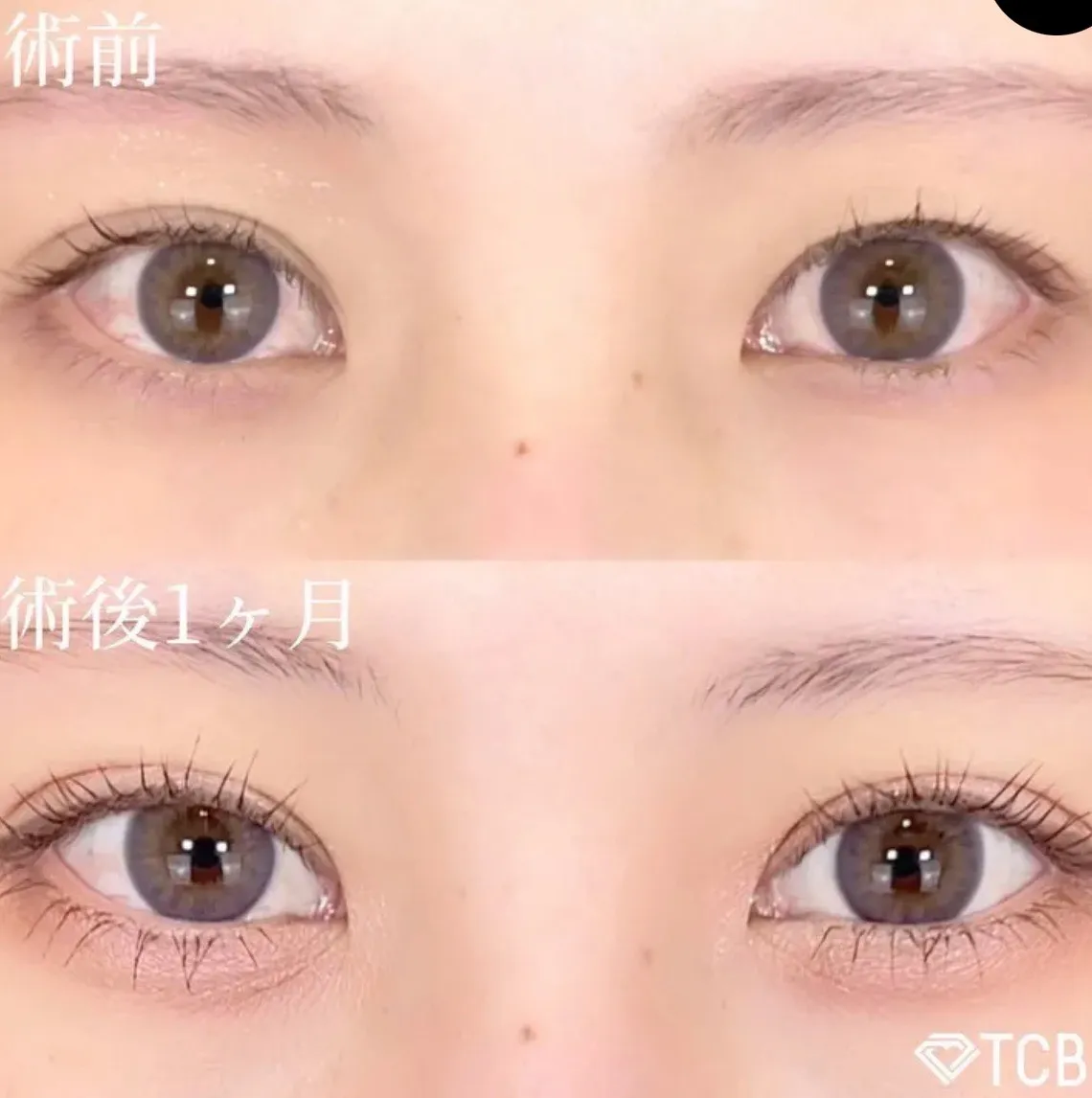 TCB二重の症例②