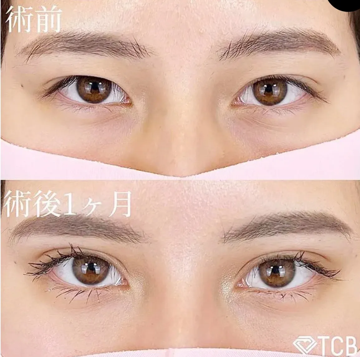 TCB二重埋没法の症例③