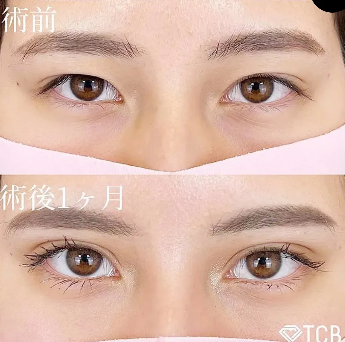 TCB二重の症例③