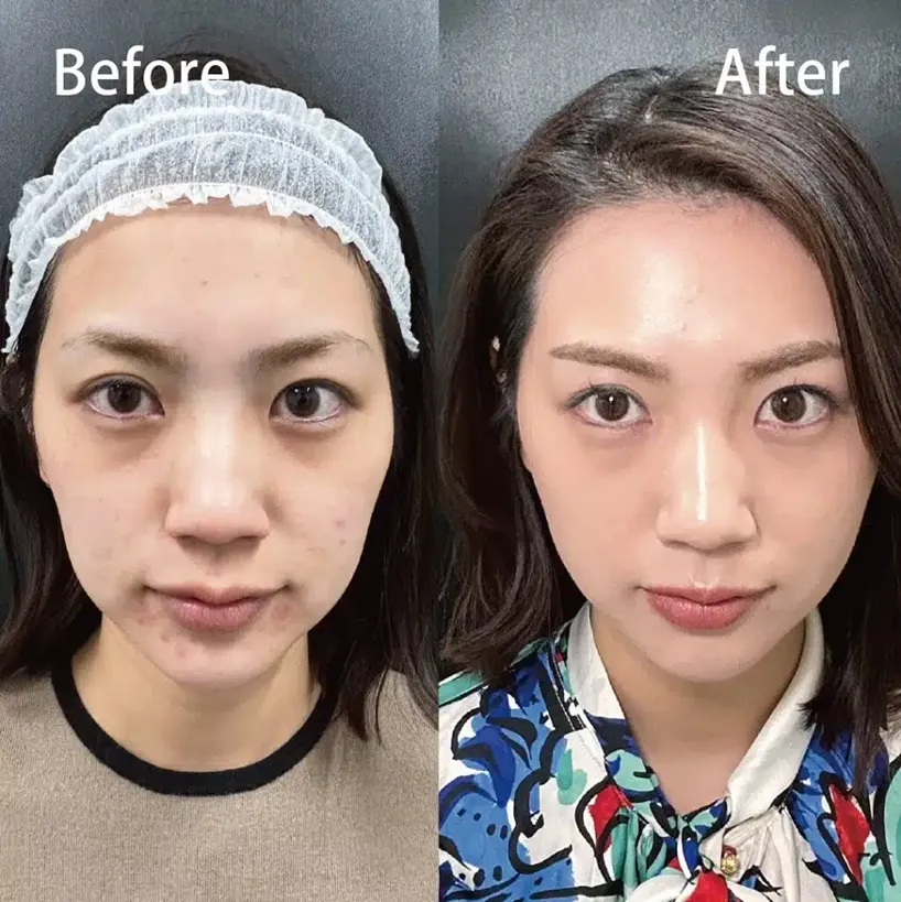 eクリニックの糸リフトの症例