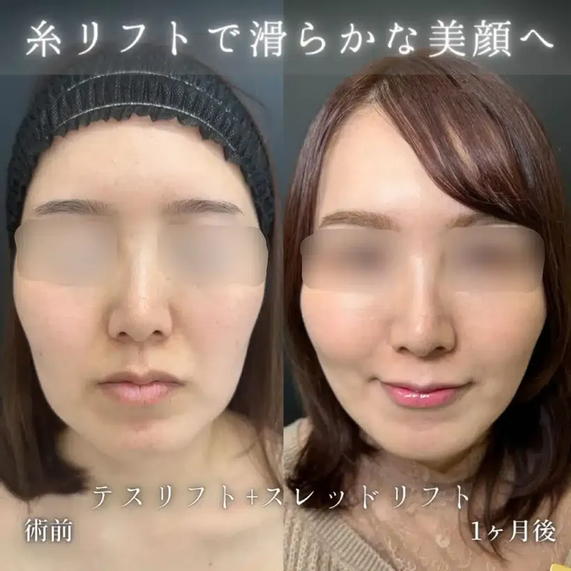eクリニックの糸リフトの症例