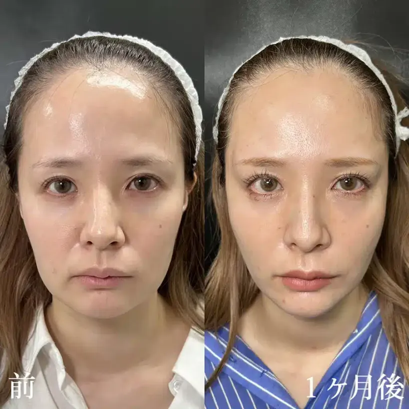 eクリニックの糸リフトの症例