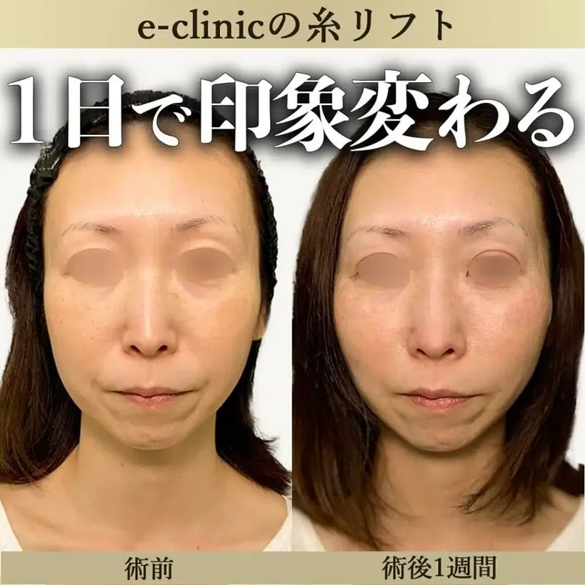 eクリニックの糸リフトの症例