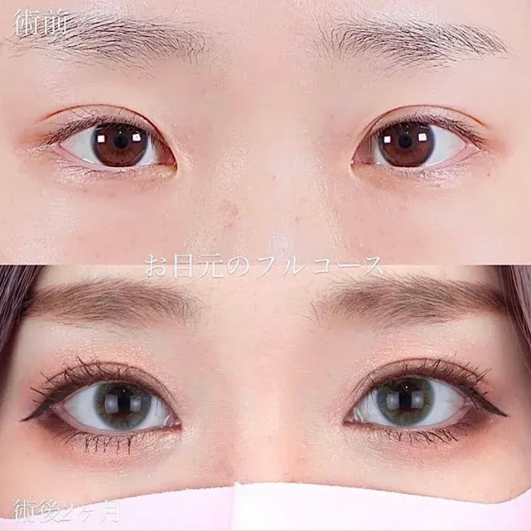 二重埋没の症例モデル