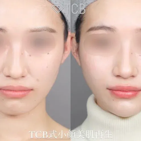 リフトアップの症例モデル