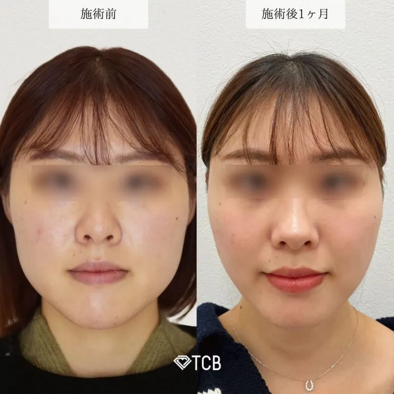 TCBエラボトックスの症例写真