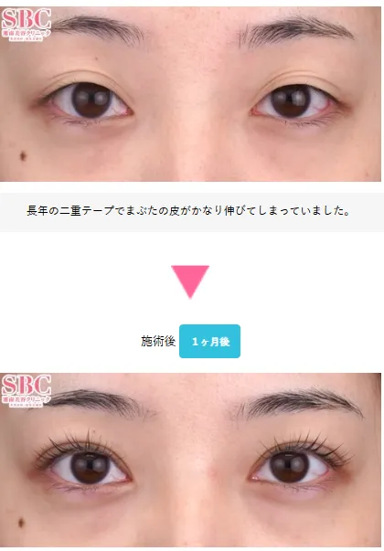 SBCフォーエバー二重術の症例② SBC 大阪京橋院年代不明 男性