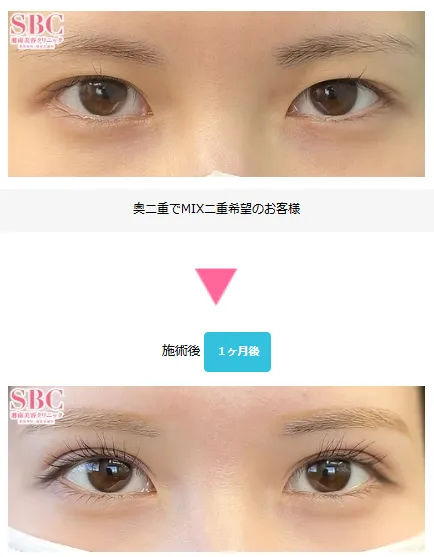 SBCフォーエバー二重術の症例