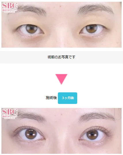 SBCフォーエバー二重術の症例