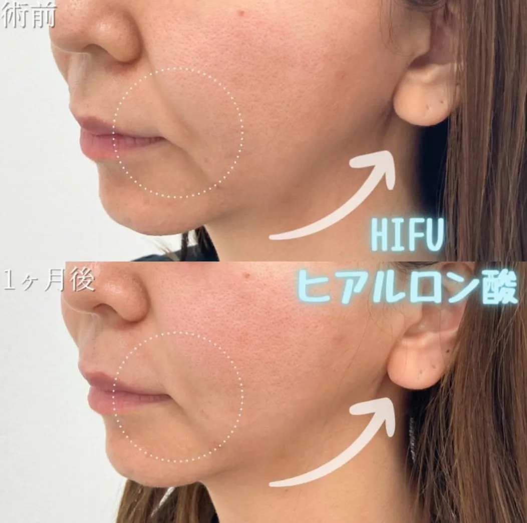 TCBハイフの症例②