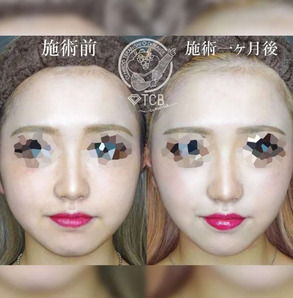 TCBハイフの症例③