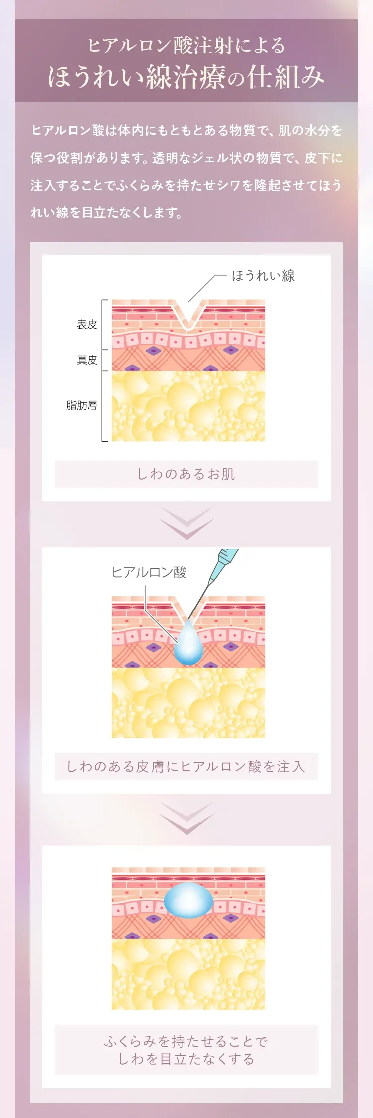 料金が安いTCBのヒアルロン酸注射における治療の仕組み