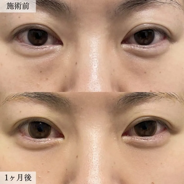 TCBのクマ取りの症例