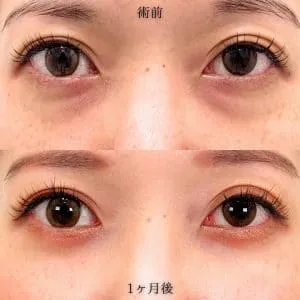 TCBのクマ取りの症例