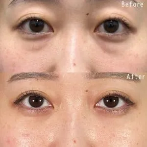 TCBのクマ取りの症例