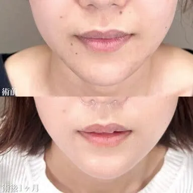 TCBのほくろ除去の症例