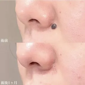 TCBのほくろ除去の症例