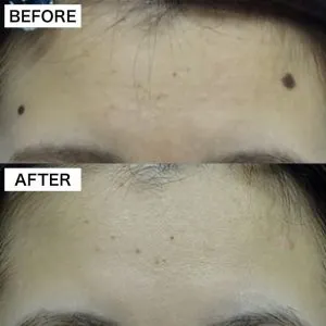 TCBのほくろ除去の症例