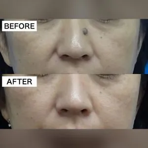 TCBのほくろ除去の症例